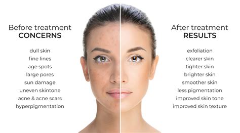 Skin Peels .
